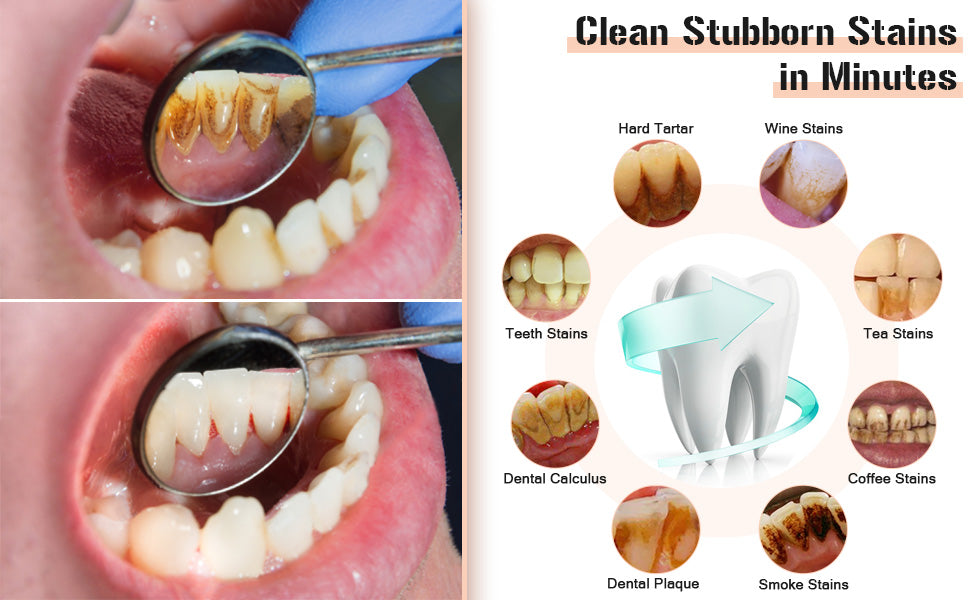 Ocallcoo electric plaque remover for teeth
Ocallcoo tartar remover with LED light
Ocallcoo ultrasonic tooth cleaner
Ocallcoo rechargeable teeth cleaning kit
Ocallcoo dental plaque and tartar remover
Ocallcoo electric tooth cleaning device
Ocallcoo teeth whitening and cleaning tool
Ocallcoo plaque remover with replaceable heads
Ocallcoo professional tooth cleaner
Ocallcoo LED dental cleaning tool